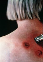 /album/consultora-medico-legal/quemadura5-jpg/